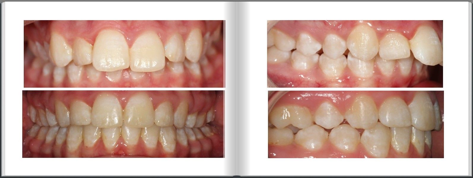 Overbite braces correction with extractions